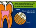 /album/dentinal-sensitivity/dentinal-sensitivity-1-jpg/